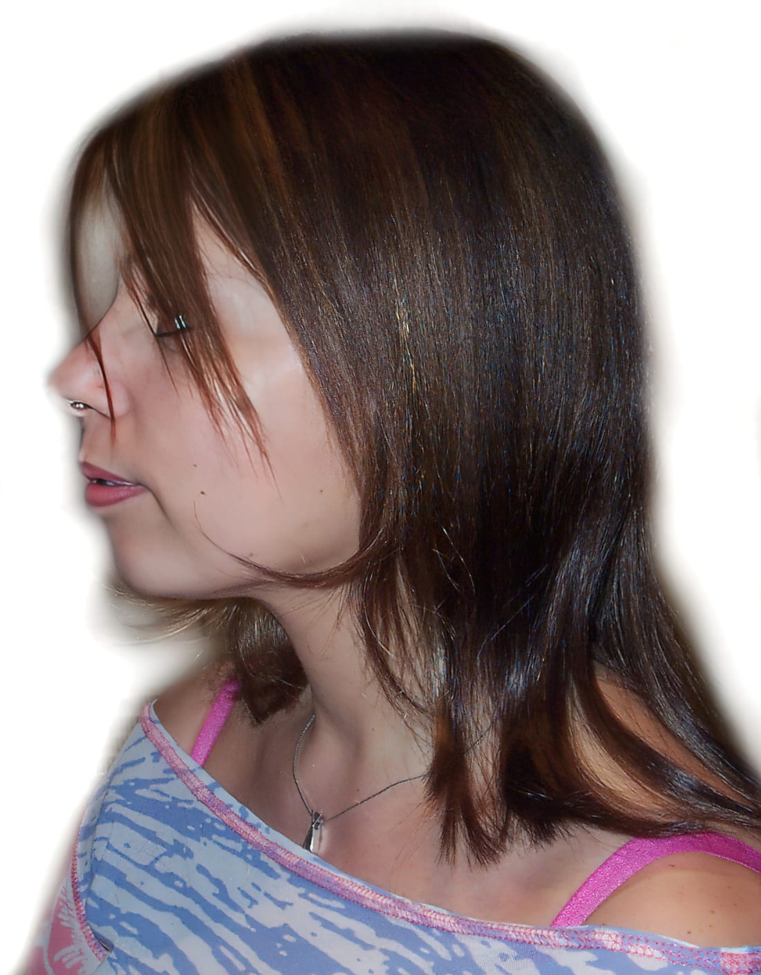 After Picture - Alopecia Areata